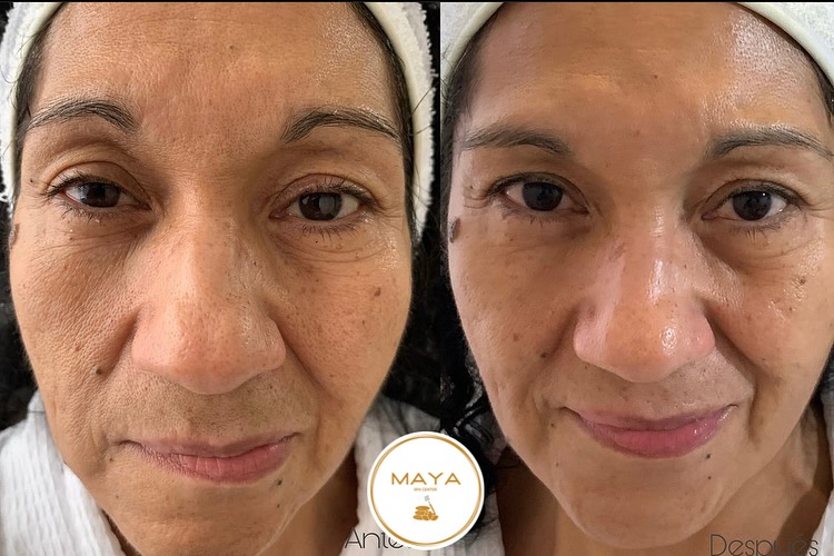 Comparativo visual antes y después de cuidado facial